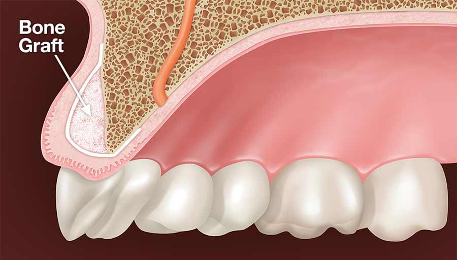 Bone Grafting