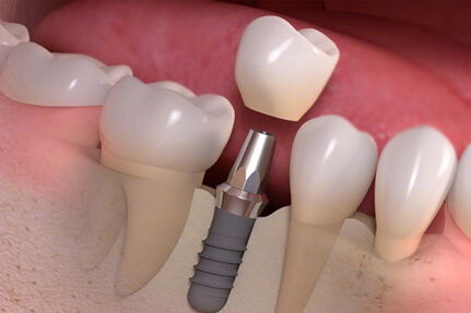 Dental-Implants